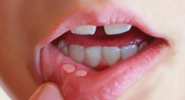 Bé bị nhiệt miệng nên ăn gì