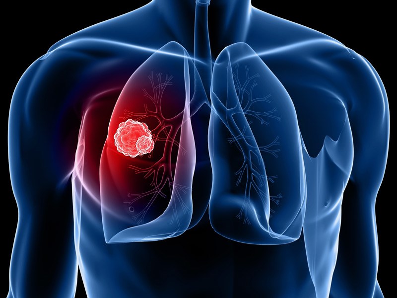 Chế độ ăn chữa khỏi bệnh ung thư phổi