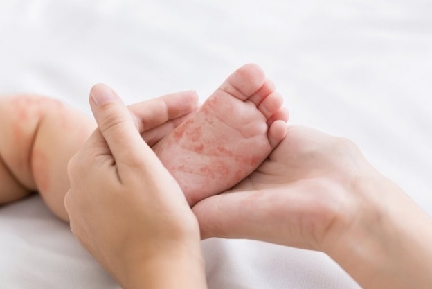 Trẻ bị dị ứng đạm sữa bò có thể gặp tình trạng chàm nhẹ hoặc trung bình trên cơ thể. 