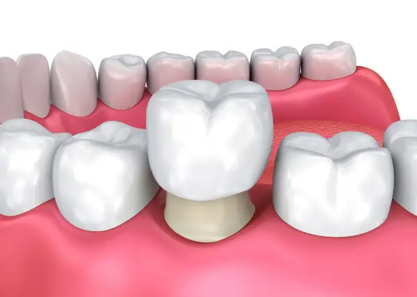 Người mới bọc răng sứ nên kiêng gì, ăn gì để có hàm răng khỏe mạnh