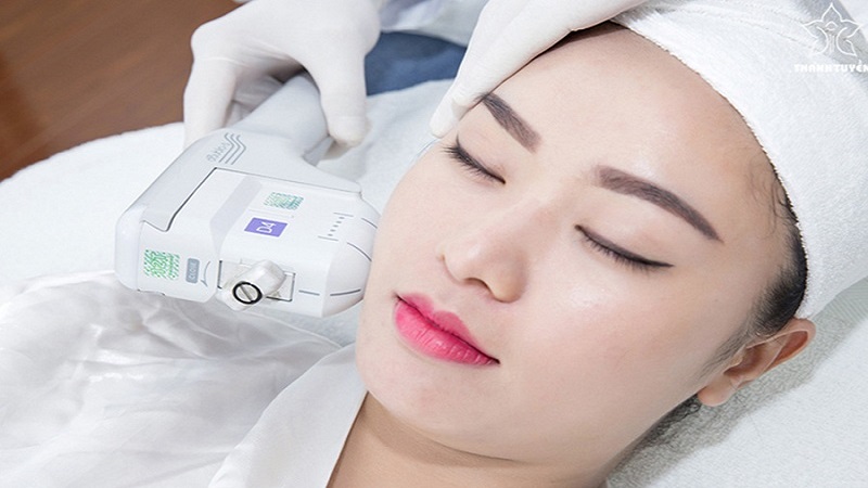 đi tia laser xóa nếp nhăn rãnh cười