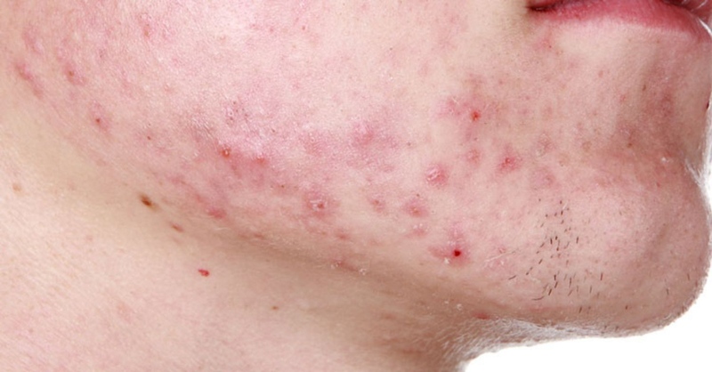 Mụn mủ bị vỡ có sao không