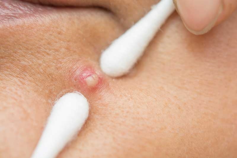Xử lý mụn mủ bị vỡ