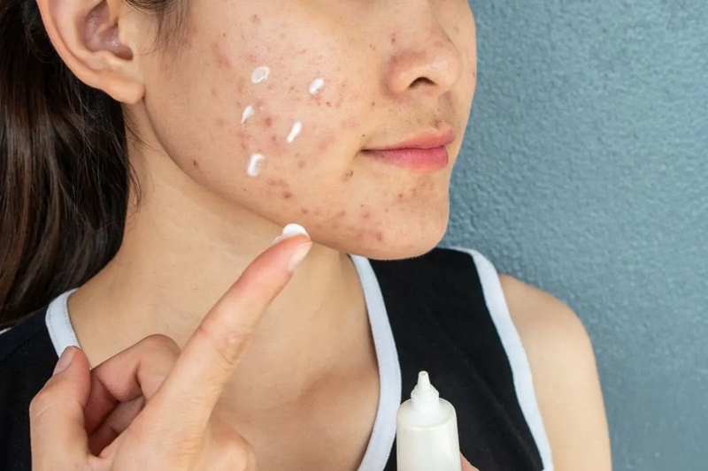 Bôi kem trị mụn mủ bị vỡ